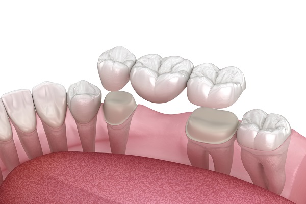 When Is A Dental Bridge Commonly Used?